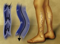 Рисунок 3. Варикоз – противопоказание для использования массажера для ног